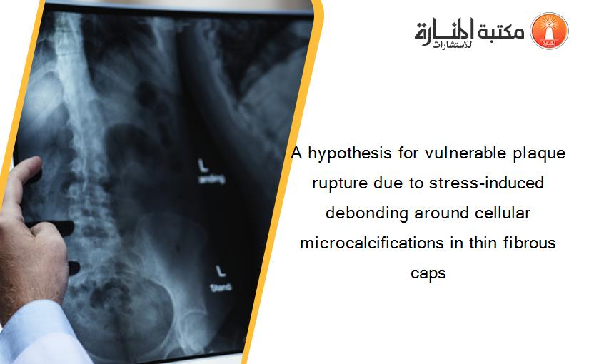 A hypothesis for vulnerable plaque rupture due to stress-induced debonding around cellular microcalcifications in thin fibrous caps