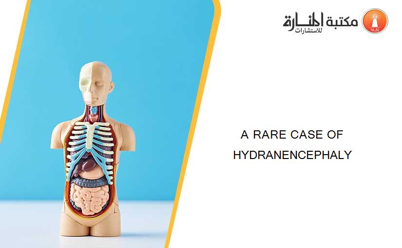 A RARE CASE OF HYDRANENCEPHALY